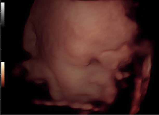 3D 4D胎儿超声图像(孕妇20周三维胎儿)图片下载