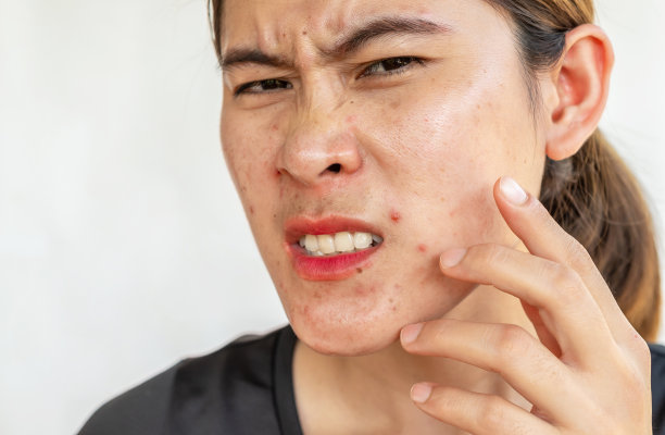 亚洲妇女有痛苦的痤疮在她的脸上发炎。图片下载