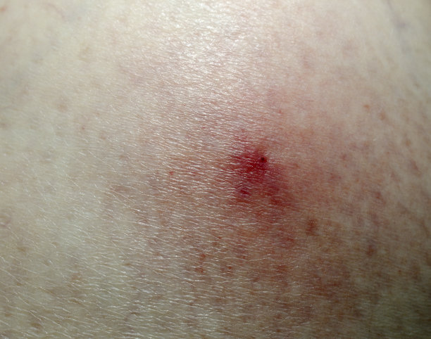 皮肤发红，蜱虫咬痕图片下载