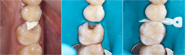 用复合填料治疗龋病图片下载