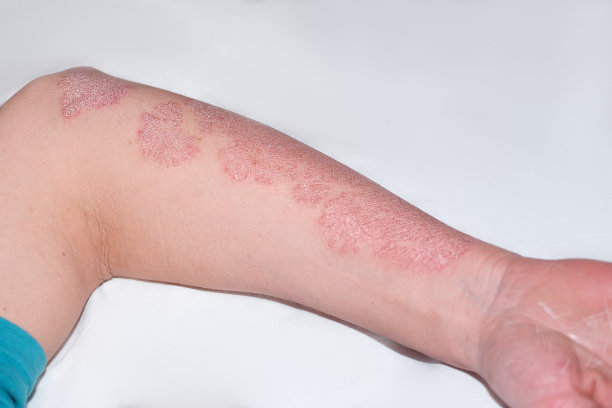 男性手有银屑病。医学问题是牛皮癣。湿疹皮肤病男性手上的牛皮癣图片下载