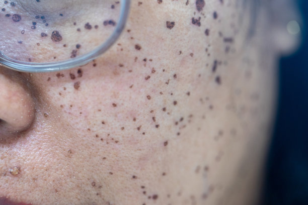 临床中因面部痤疮引起皮肤损伤的背景。图片下载