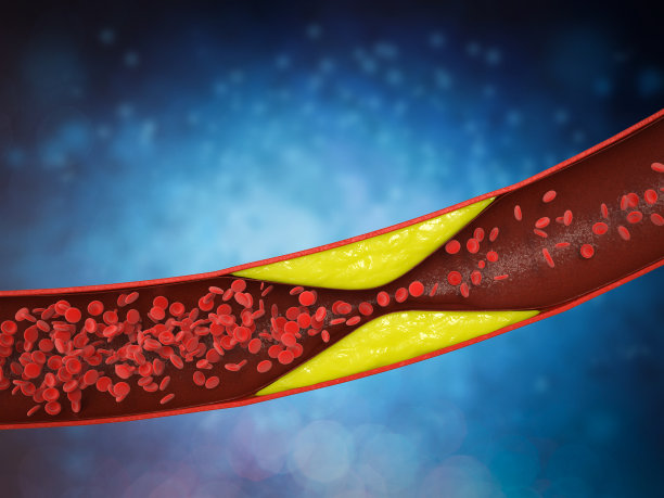 血管内有斑块的动脉粥样硬化图片下载