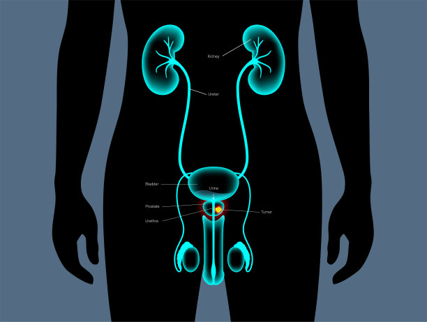 前列腺癌的概念图片下载