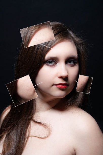 年轻女性去除痤疮前后。女人护肤概念。拼贴画肖像图片下载