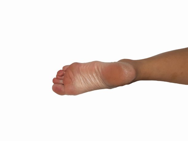 脚后跟干裂，粗糙，白色背景下缺乏保养。图片下载