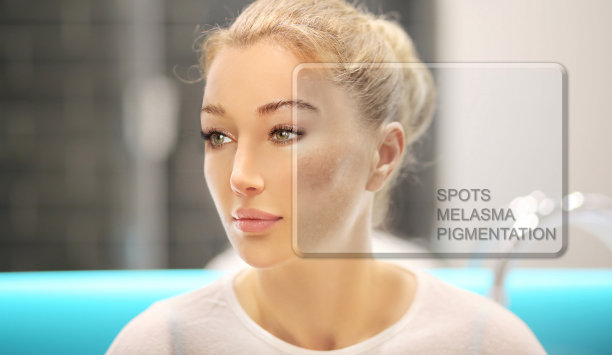 黑斑，雀斑，色素沉着(黄褐斑或黄褐斑)，概念-皮肤美白，皮肤美白，果酸，AHA，亮肤。图片下载