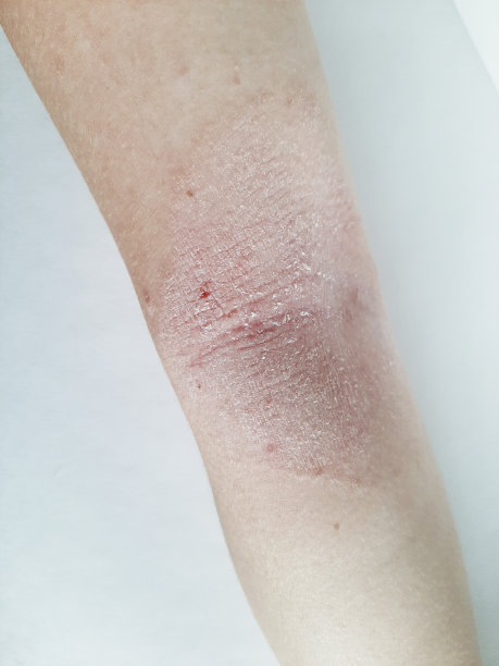 婴儿手上有干红斑图片下载