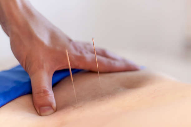 一个男人正在用针灸治疗他的背部。图片下载