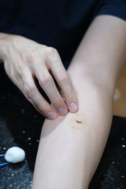 特写照片的伤疤与针。清洁缝合伤口。一个男性手臂上缝合的伤口的特写。图片下载