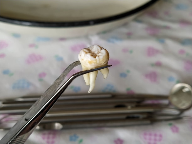 拔牙在镊子背景上的牙科器械特写图片下载