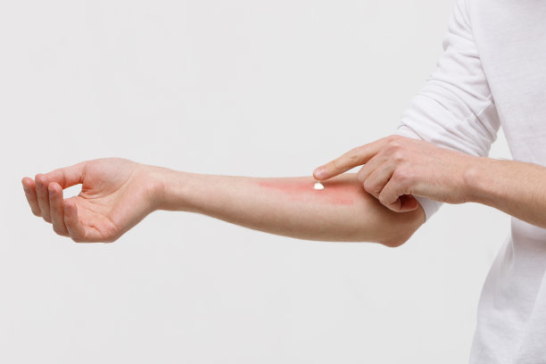 男子在肿胀的皮肤上涂药膏图片下载