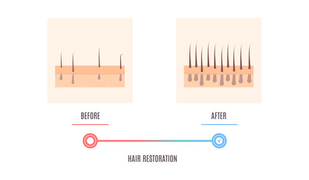 头皮皮肤横切图显示头发恢复结果图片下载