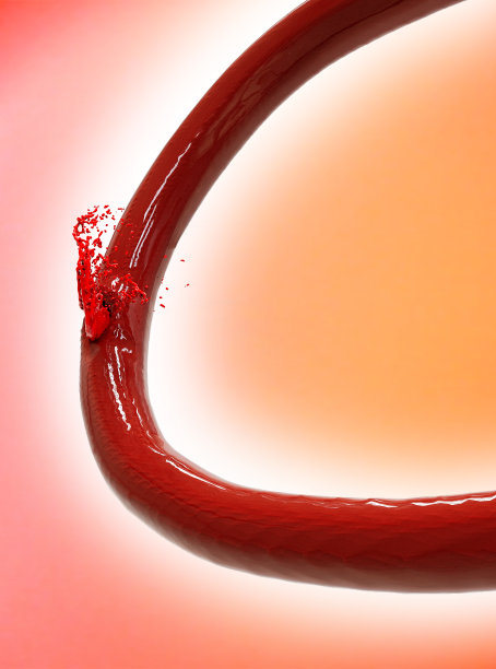 出血性中风。动脉破裂，或多或少会造成大面积出血并损伤脑组织。脑损伤图片下载