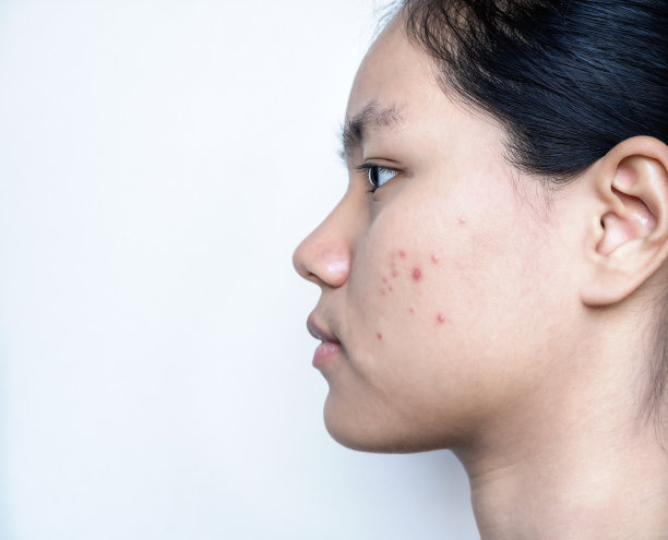 一个年轻女士的近景与典型的青少年痤疮，丘疹，疤痕问题。有白底粉刺问题的少女，面部皮肤问题和女性护肤理念。图片下载
