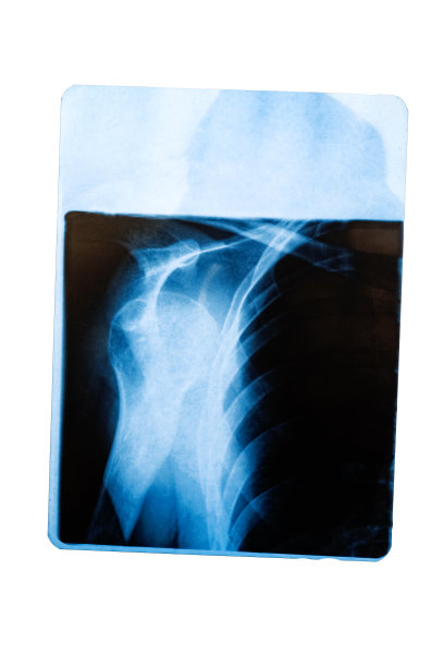 白色背景下肩部隔离x光片图片下载