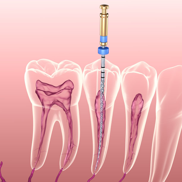 根管治疗过程。医学上准确的牙齿3D插图。图片下载