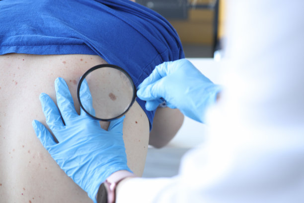 医生用放大镜近距离检查病人的色素痣图片下载