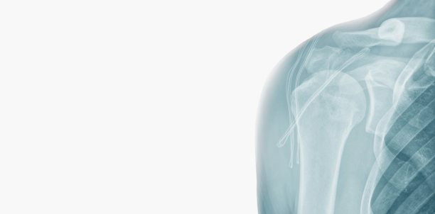 在白色背景上孤立的肩膀的x线图像。挂二头肌肌肉。术后慢性二头肌长肌腱脱位。(重建头颅三分之一的SSC肌腱螺旋锚)图片下载