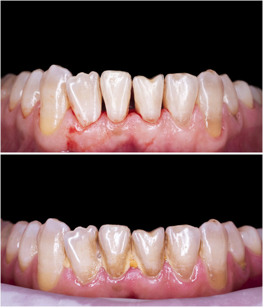牙齿清洁前后的图片图片下载