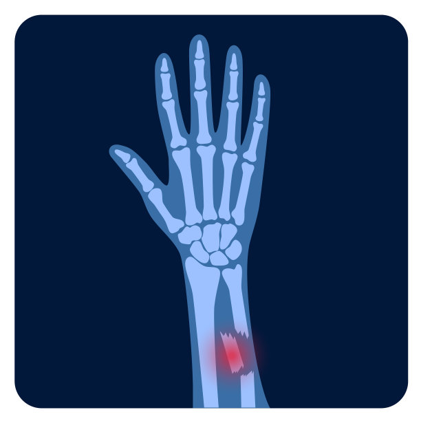 骨折x射线概念图片下载