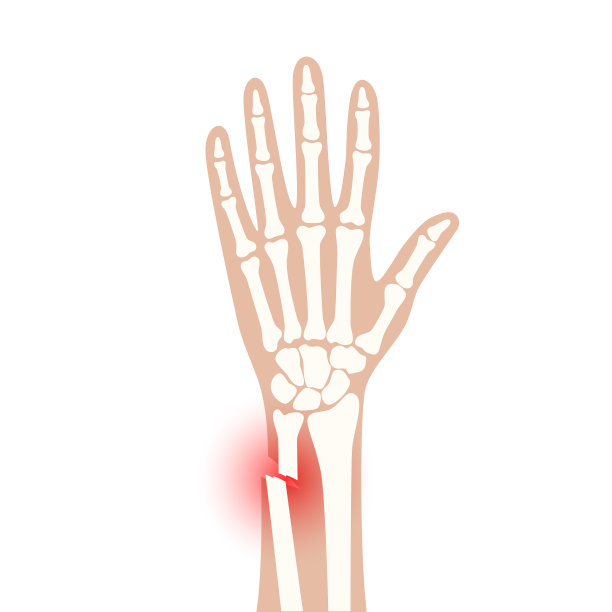 骨折x射线概念图片下载