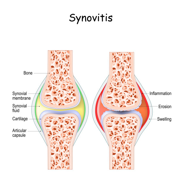 滑膜炎。关节健康，关节有滑膜炎症。图片下载