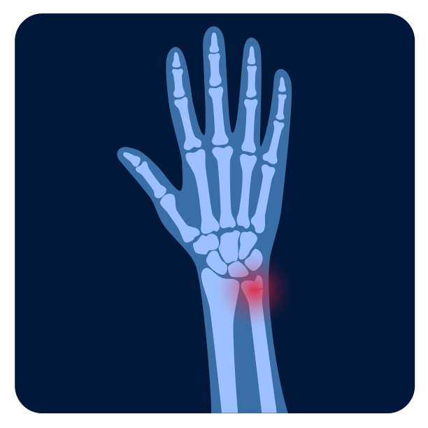 骨折x射线概念图片下载