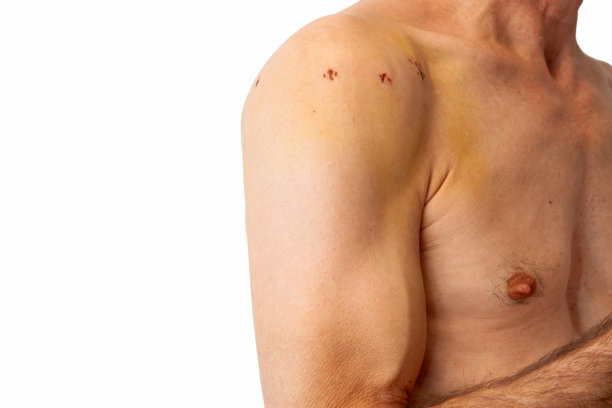 男性肩关节镜手术后有疤痕。术后慢性二头肌长肌腱脱位。图片下载