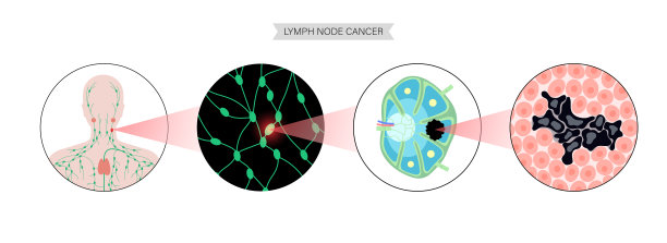淋巴瘤癌症的概念图片下载