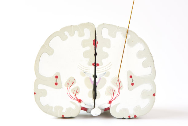 帕金森手术中苍白球的微电极记录图片下载