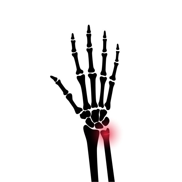 骨折x射线概念图片下载