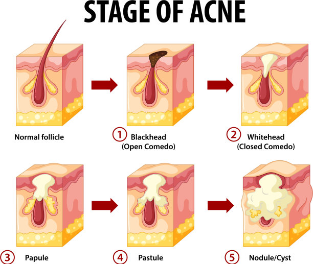 阶段皮肤痤疮解剖图片下载