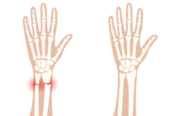 骨折x射线概念图片下载