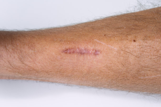 他的腿缝合后留下了疤痕。缝合后留下的疤痕图片下载