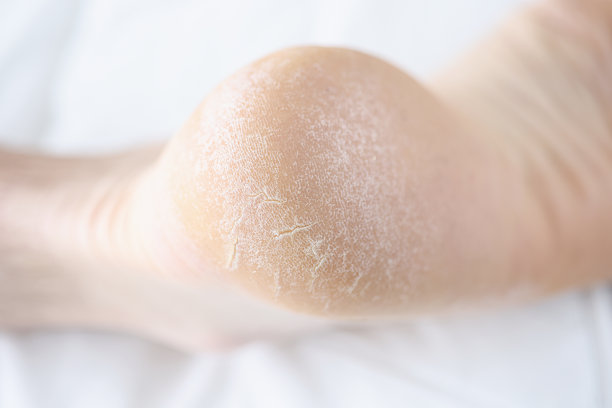 腿与鳞片和龟裂的脚跟特写图片下载