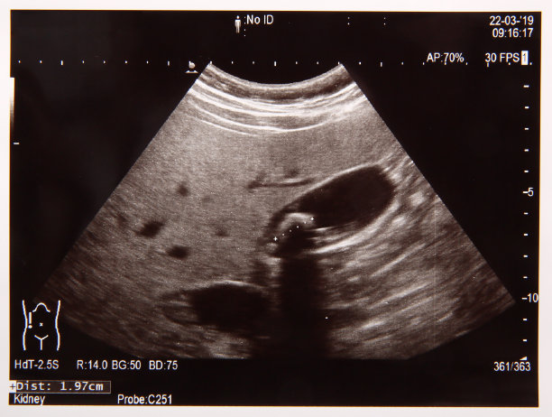 超声检查显示胆囊内有结石图片下载