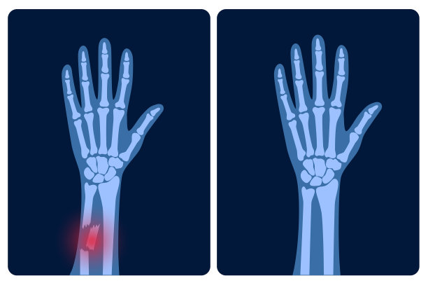 骨折x射线概念图片下载