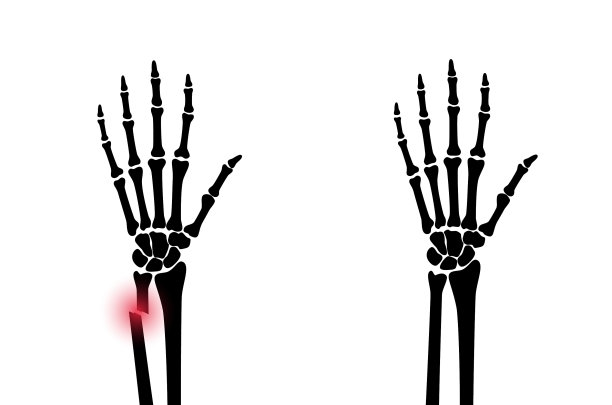 骨折x射线概念图片下载