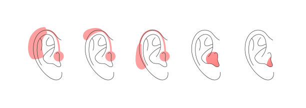 聋人和助听器的概念。矢量平面插图集。收集助听器装置的轮廓人耳轮廓孤立在白色。医药、保健设计元素。图片下载