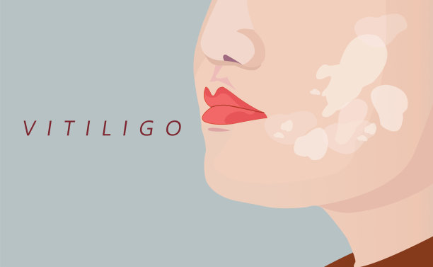 近距离观察女性脸上的白癜风皮肤问题图片下载