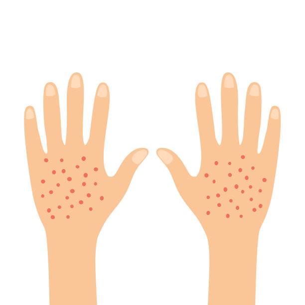 红色皮疹在背部女性手皮肤在白色的背景平坦的设计。瘙痒和刺激症状。图片下载