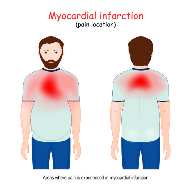 心肌梗死区域。心脏病发作。疼痛的位置图片下载
