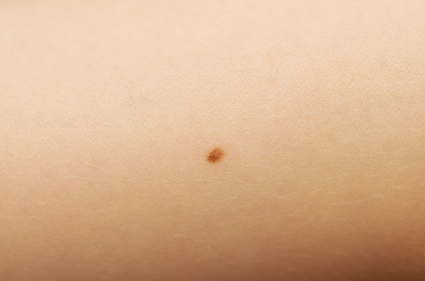 胎记在皮肤图片下载