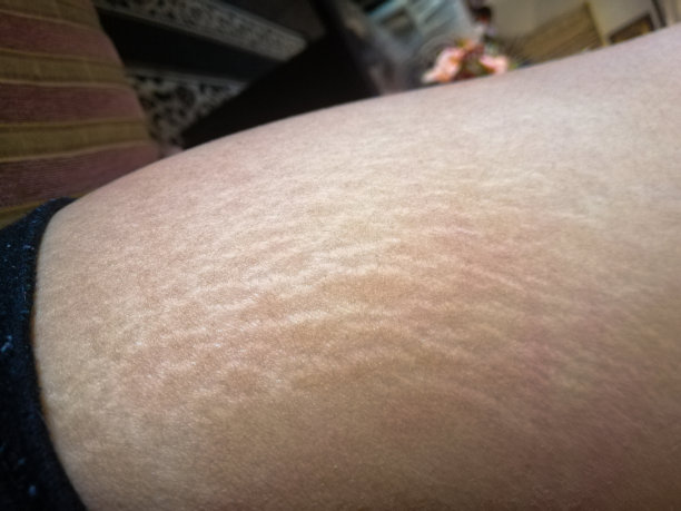 妊娠纹(虎纹)图片下载