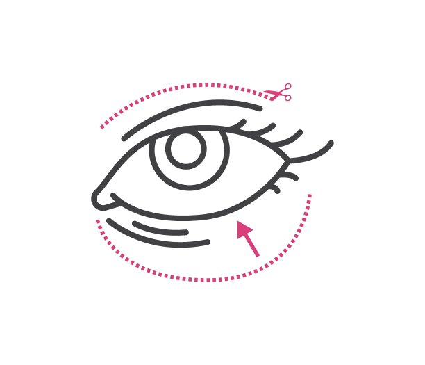 上睑缩小、上睑提拉整形的概念。眼部皱纹、面部疤痕、手术疤痕、抗衰老治疗。可编辑的矢量图标上的白色背景。图片下载