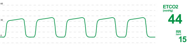 二氧化碳监测设备屏幕。ETCO2 RR和capnogram图片下载