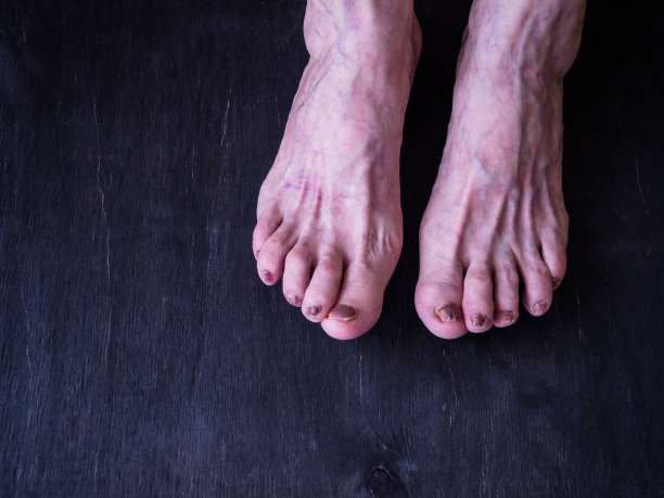 黑色背景上一位老年妇女腿部静脉曲张。图片下载