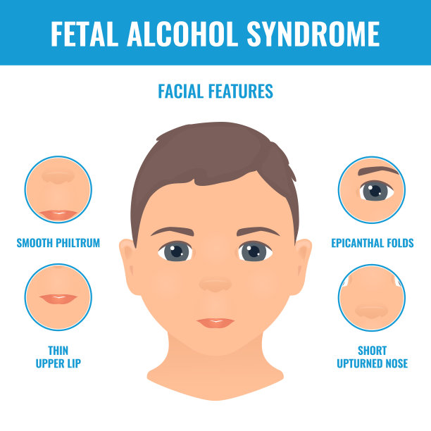 胎儿酒精综合征儿童面部特征图片下载