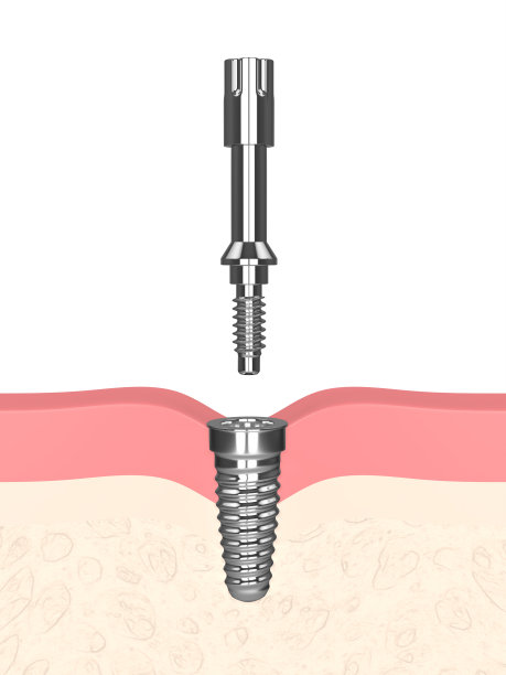 3d渲染的种植体与多peg检查种植体的稳定性图片下载